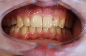 After - Abacus Dental