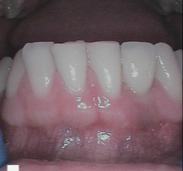 After -Abacus Dental