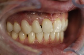 Before - Abacus Dental