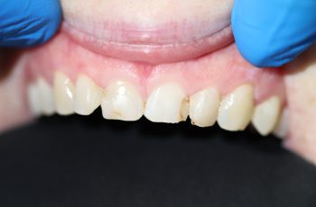 Before - Abacus Dental