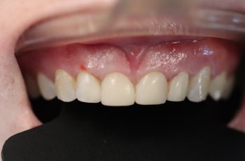 After - Abacus Dental