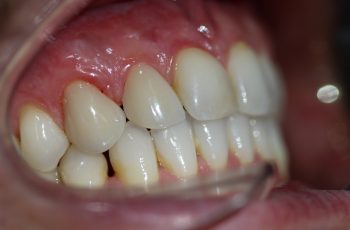 After - Abacus Dental