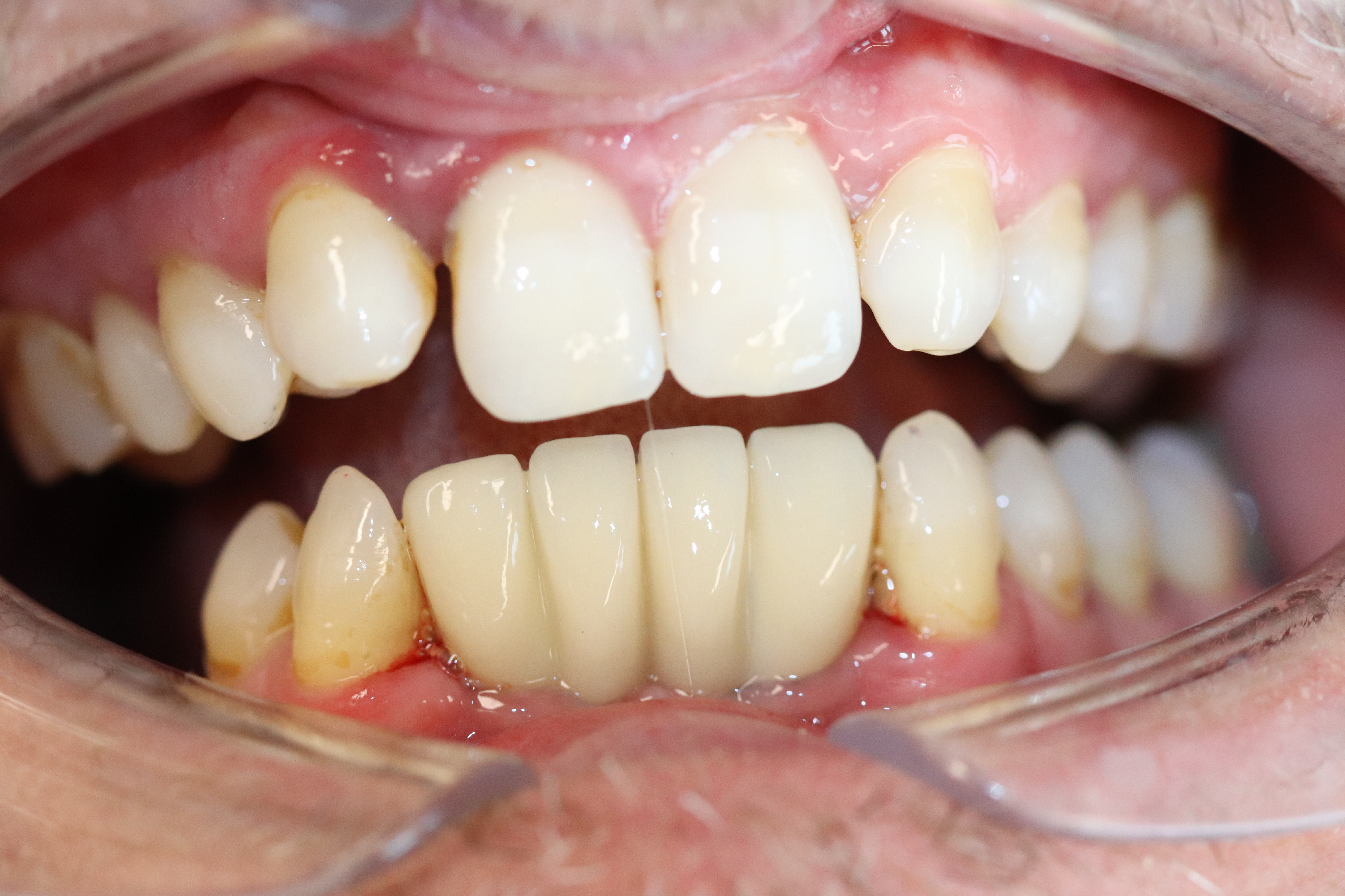 After -Abacus Dental