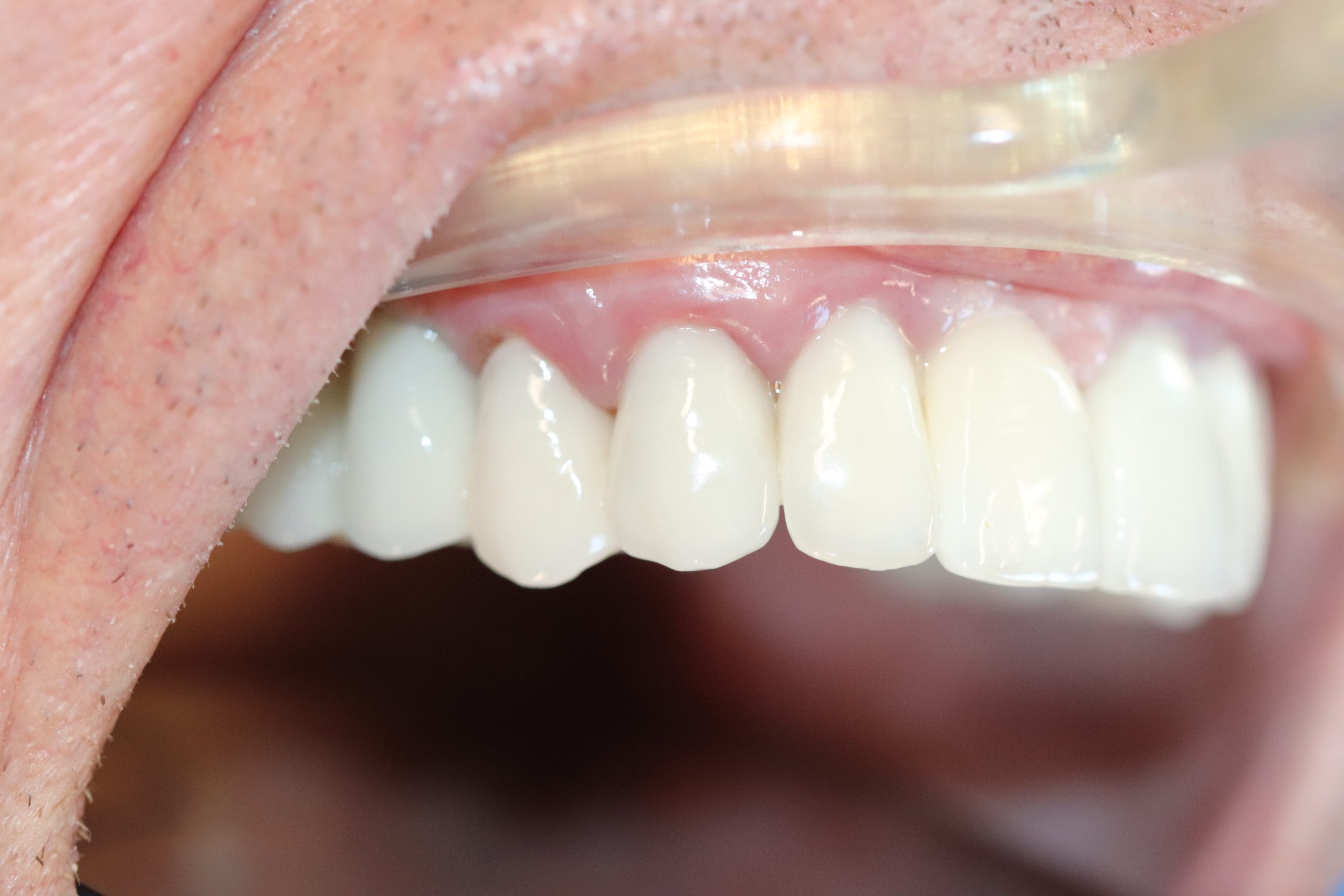 After -Abacus Dental
