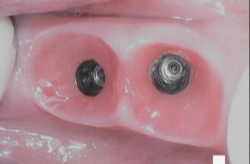 Before - Abacus Dental