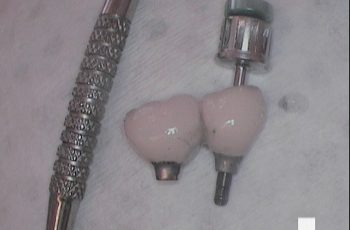 After - Abacus Dental